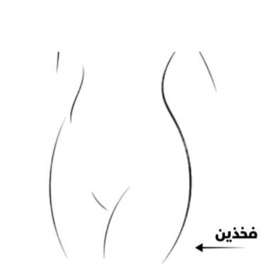 تشققات الفخذين